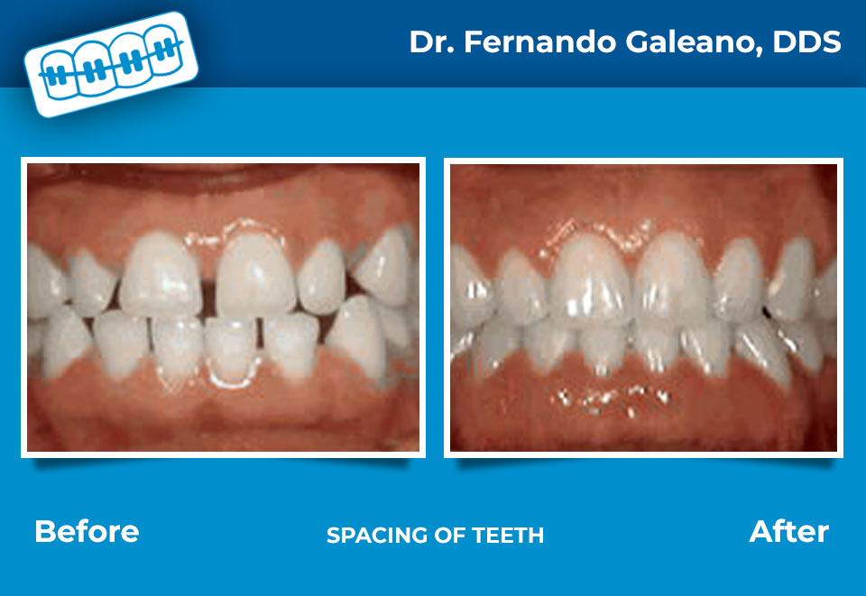 Before and after: spacing of teeth corrected with braces